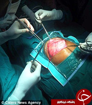 (تصویر) نوزاد دختری که دوقلو باردار بود! (تصویر) نوزاد دختری که دوقلو باردار بود!