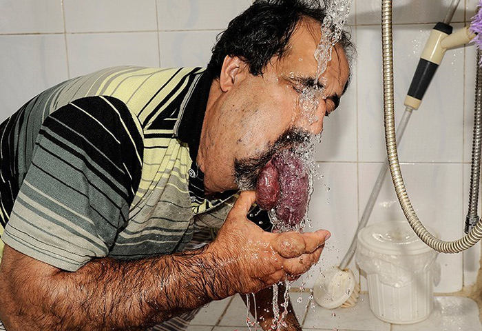 (تصاویر) بیماری دردناک اسماعیل (تصاویر) بیماری دردناک اسماعیل