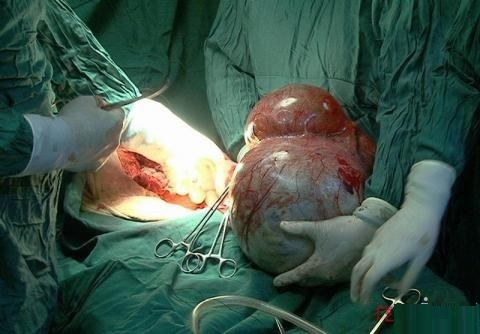 خارج کردن توده ۱۲ کیلوبی از شکم پیرزن مراغه‌ای