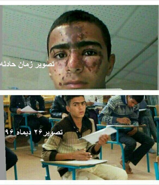 جزئیات حادثه سوختگی صورت دانش‌آموز زهکی در مدرسه
