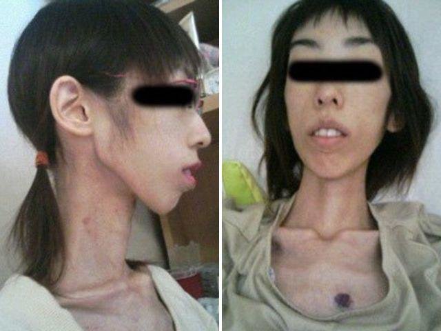 (تصاویر) شکنجه دختر جوان با ۱۷ کیلوگرم وزن!