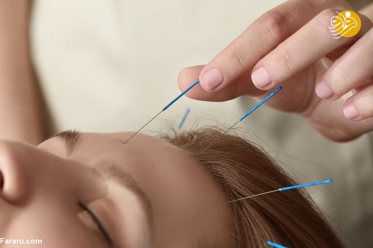 طب سوزنی چیست؟