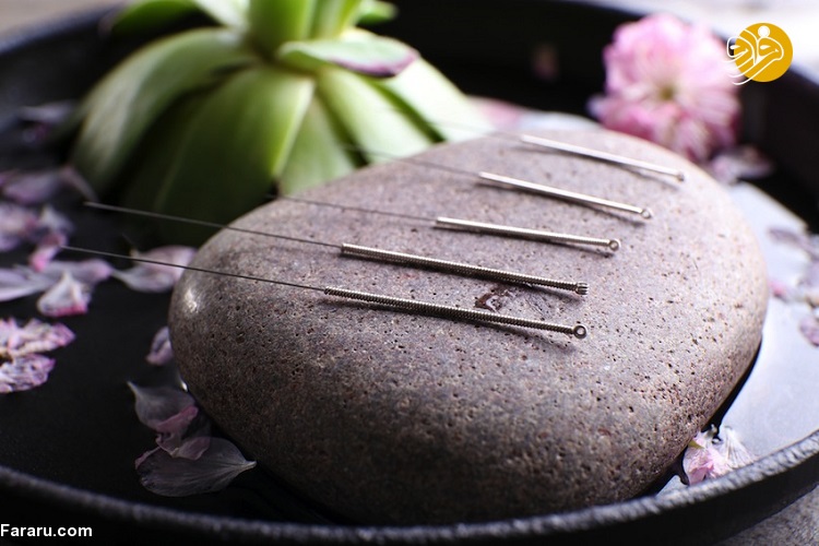 طب سوزنی چیست؟