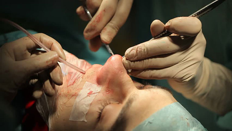تفاوت جراحی بینی به روش باز و بسته