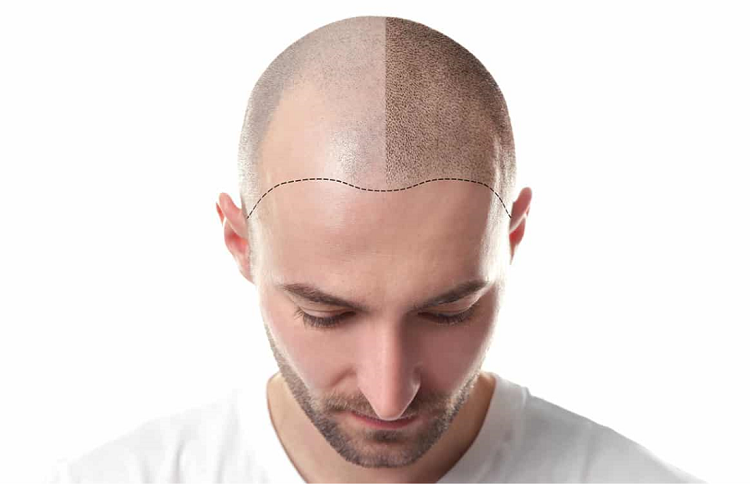 کاشت مو علت ریزش مو در مردان چیست و چگونه درمان میشود؟