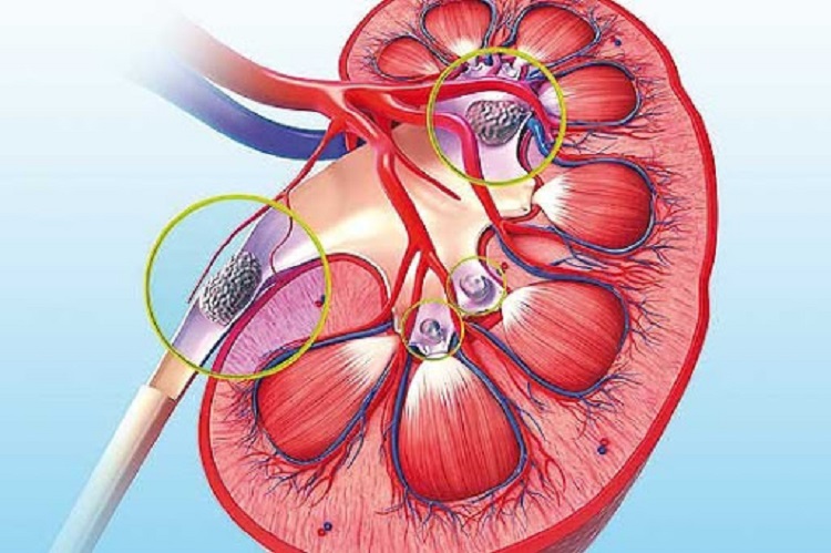 سنگ کلیه چیست؟ سنگ کلیه؛ علل، نشانهها و راههای درمان و پیشگیری از آن
