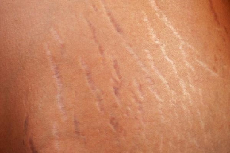 ترکهای پوستی چیست؟ ترکهای پوستی؛ علل و راههای درمان آن