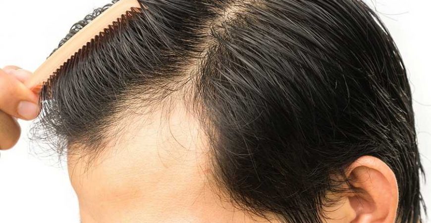 نکات مهم قبل و بعد از کاشت مو