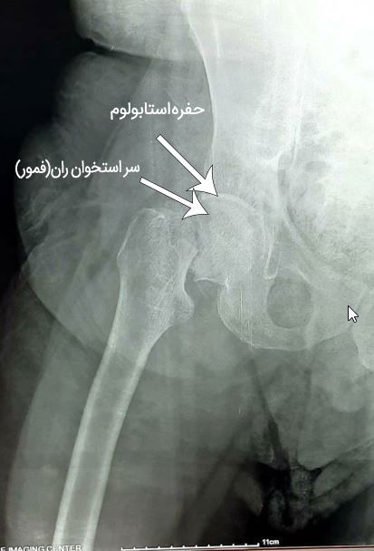 فیزیوتراپی در سندروم گیرافتادگی فمور و استابولار