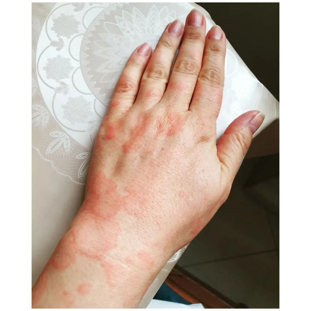 عکس‌هایی از بیماری آناهیتا همتی در اثر آلودگی هوای تهران