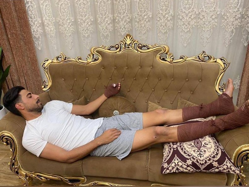 (تصویر) سوختگی شدید بازیکن داماش بعد از نجات همسایه از آتش