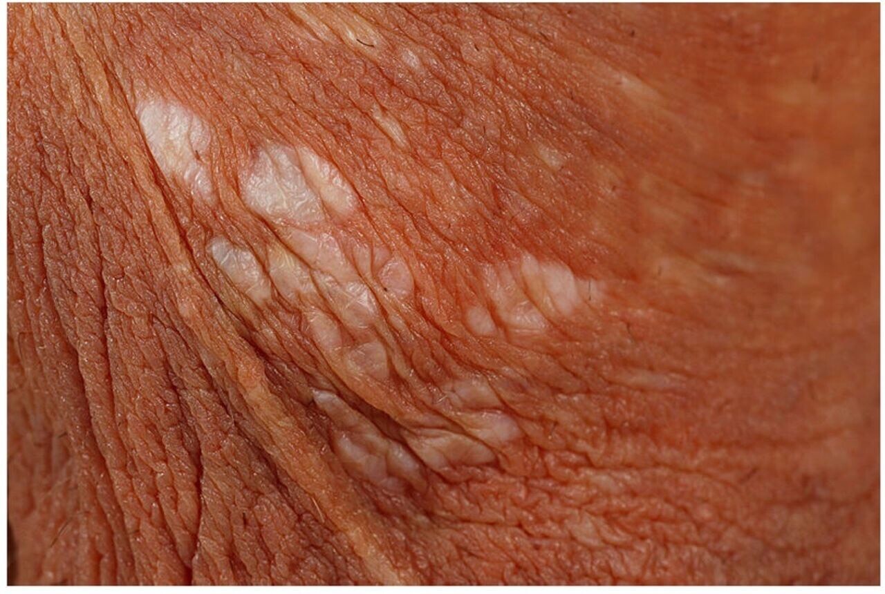 (عکس) لیکن اسکلروز؛ اختلال التهابی پوست اندام تناسلی / علت، نشانه ها، پیشگری و درمان