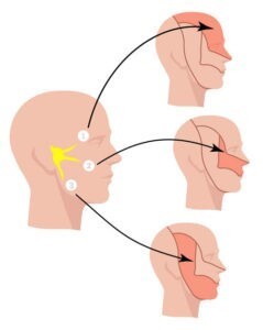 آیا دردهای عصب سه قلوی صورت درمان قطعی دارد؟
