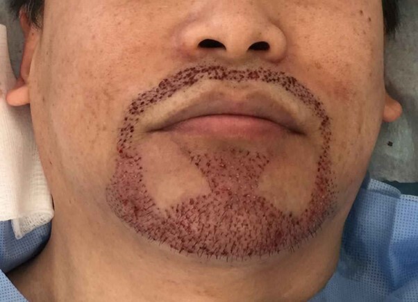 کاشت ریش مخصوص چه کسانی است و چگونه انجام می­شود؟
