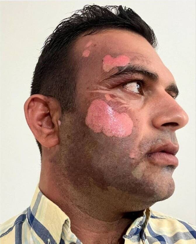 (عکس) سوزاندن صورت یک محیط‌بان توسط یک شکارچی
