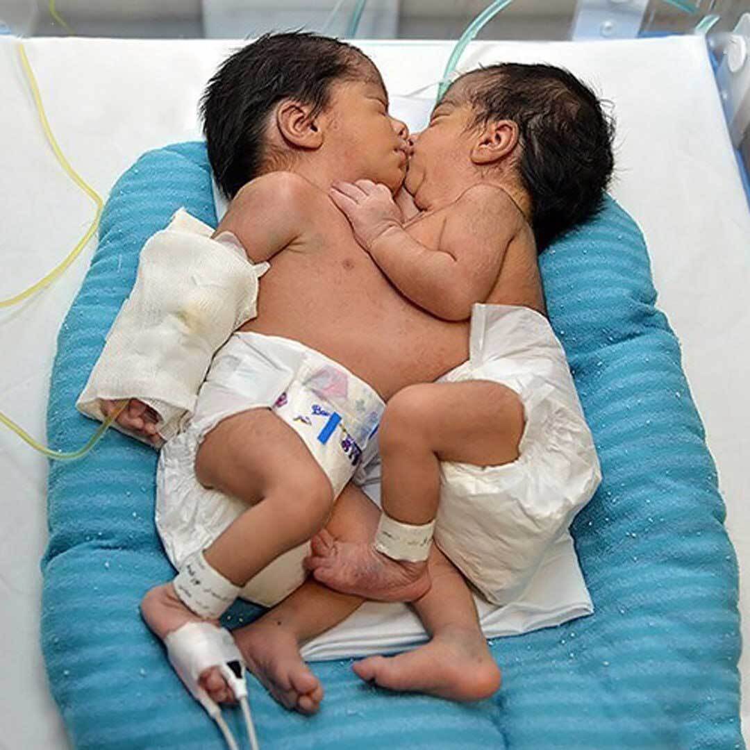 مرحله نخست جداسازی دوقلو‌های به هم چسبیده در شیراز انجام شد