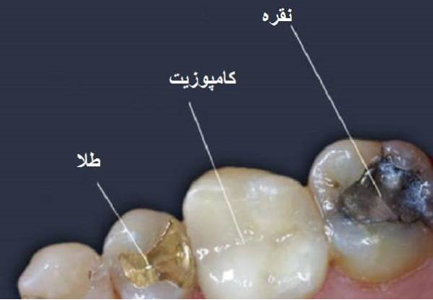 پرکردن دندان وهرآنچه که باید در مورد آن بدانید!