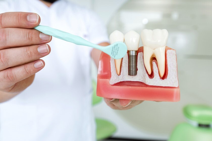 کاشت دندان بدون ایمپلنت چه مزایا و معایبی دارد؟