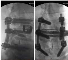 چرا رونی کلمن نمی تواند راه برود؟ چرا رونی کلمن نمی تواند راه برود؟